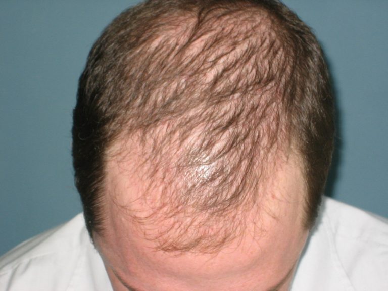 Por que meu cabelo cai?