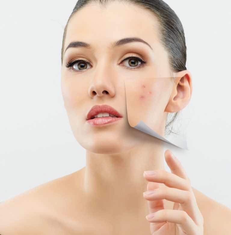 Saiba como se livrar da Acne