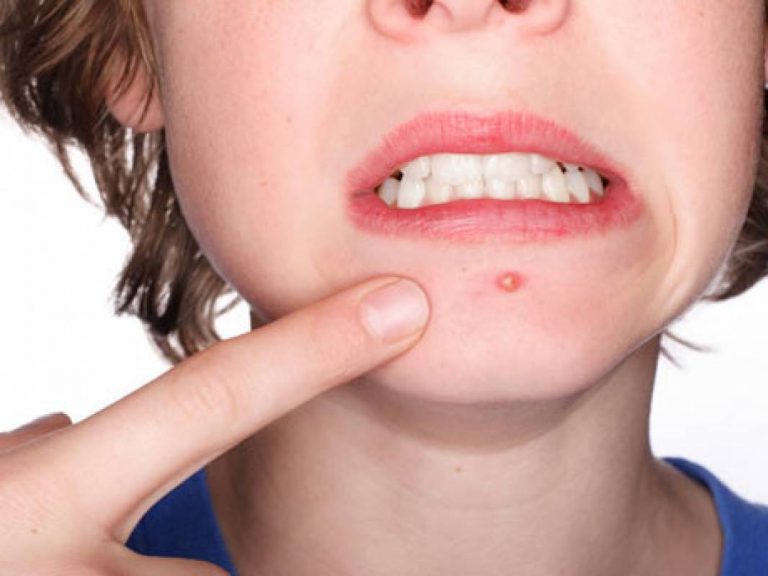Alimentos que combatem a acne